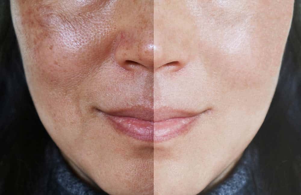 pigmentation-treatment-delhi