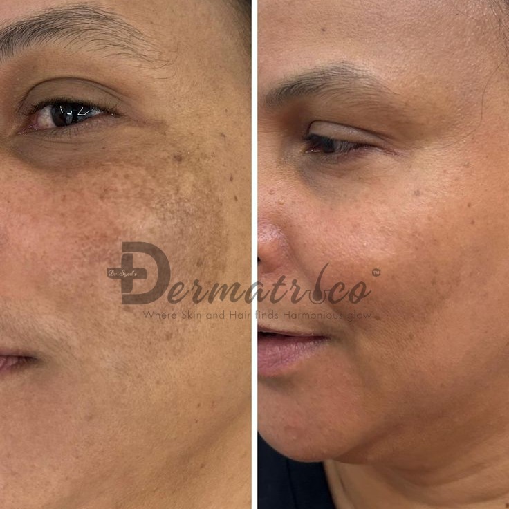 pigmentation-treatment-in-india