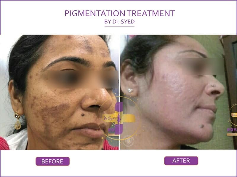 pigmentation-treatment-in-india