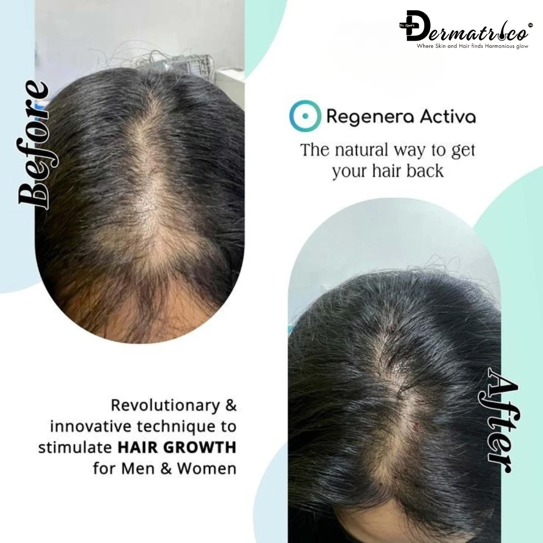 Regenera Activa - The Future of Hair Restoration