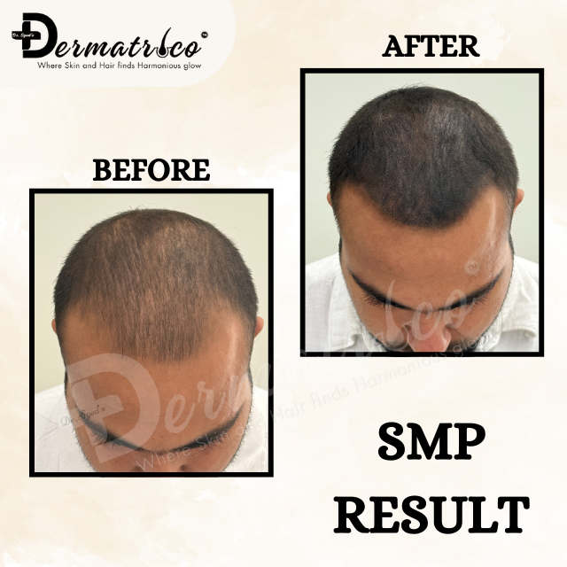Scalp-Micropigmentat-on-in-Delhi – Dermatrico
