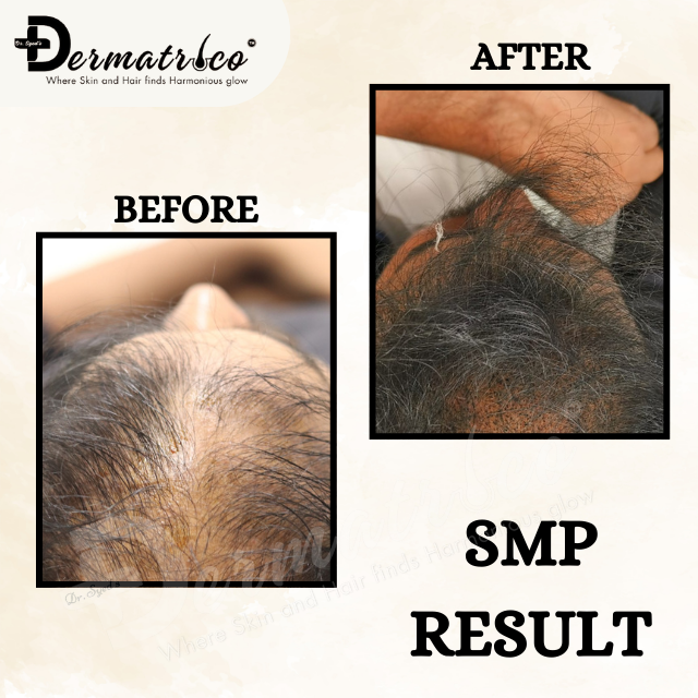 Scalp-Micropigmentat-on-in-Delhi – Dermatrico