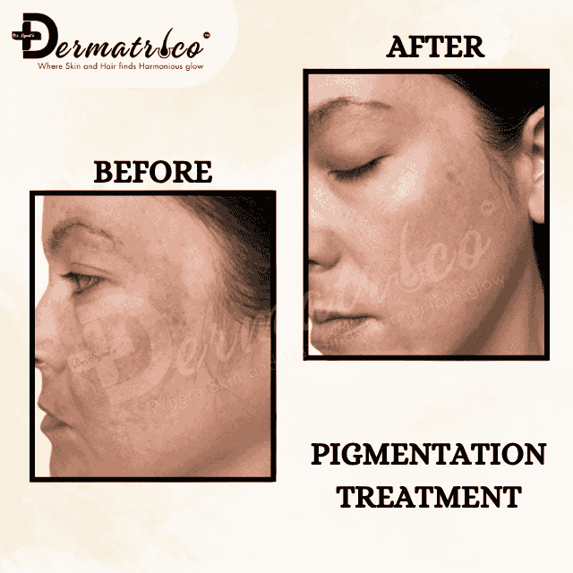 pigmantaion Best Skin Clinic Near Chhatarpur – Trusted Skin Specialist & Dermatologist