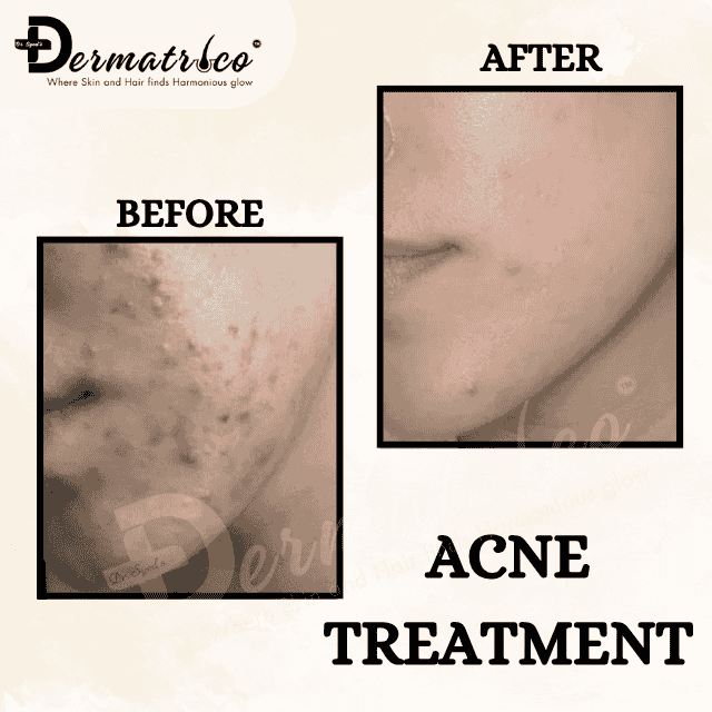 acnetreatment Best Skin Clinic Near Greater Kailash, Delhi – Trusted Skin Specialist & Dermatologist