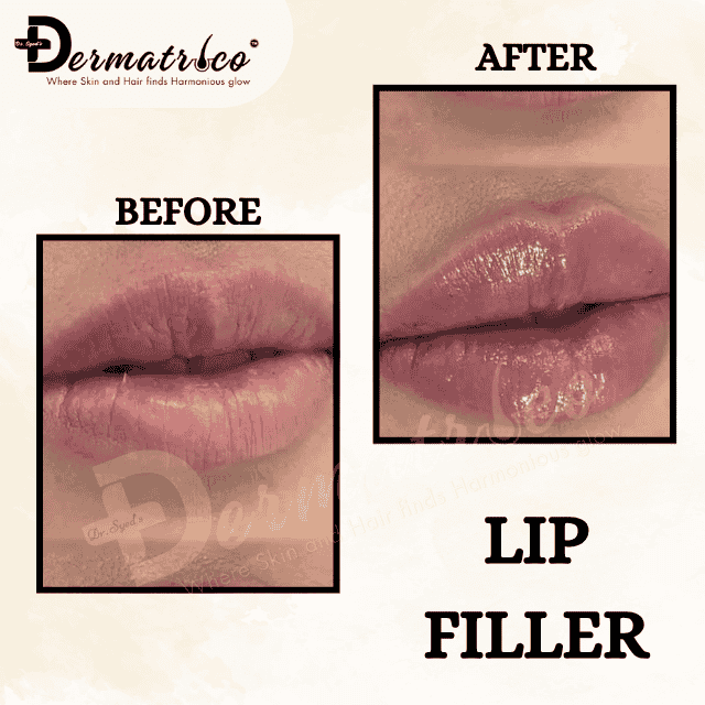 lif fillers Skin Clinic Near Greater Kailash, Delhi – Trusted Skin Specialist & Dermatologist