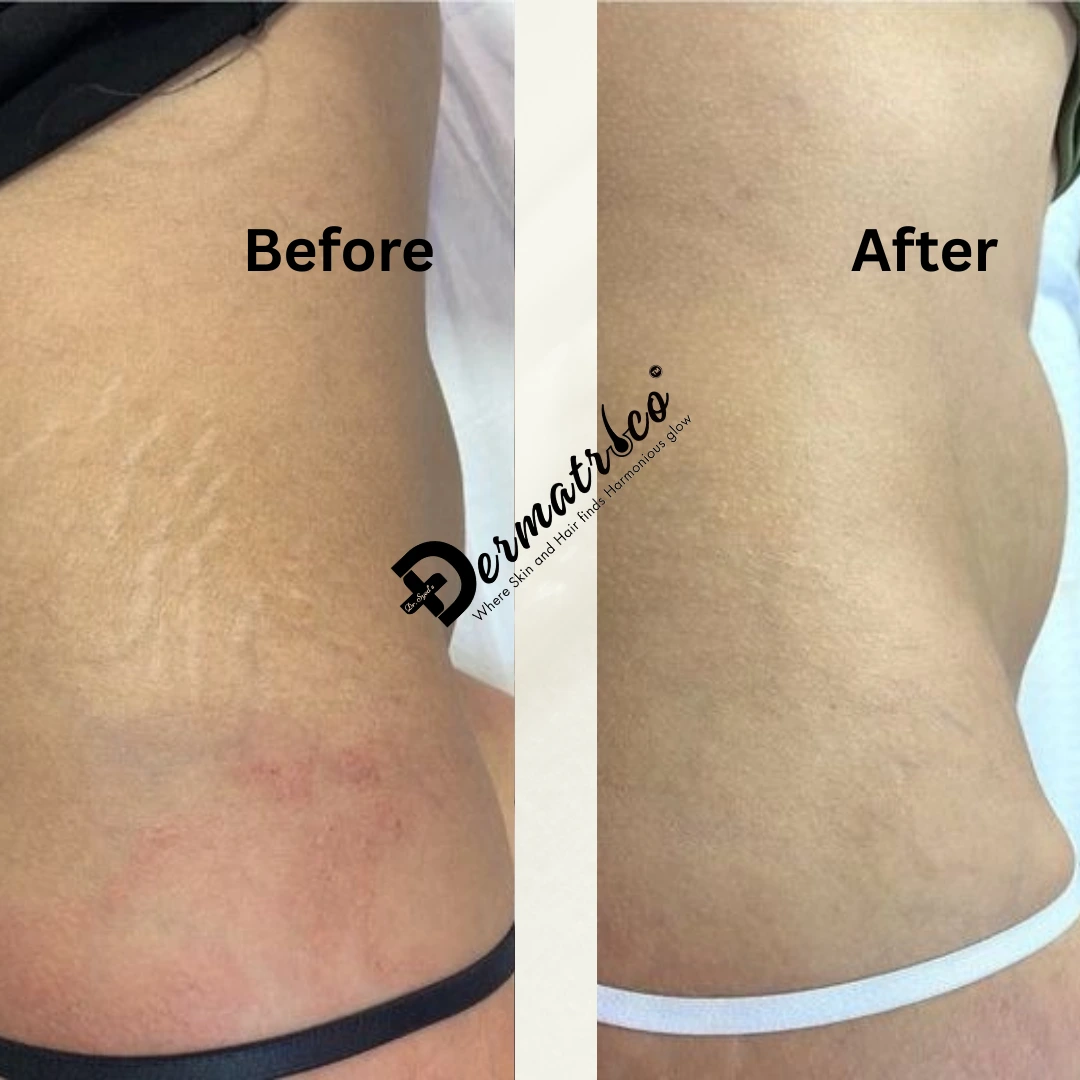 stretch-marks-treatment-in-delhi-treatment Treatment Before And After Done By Dr. Syed