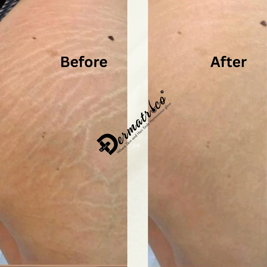stretch-marks-treatment-in-delhi-treatment Treatment Before And After Done By Dr. Syed