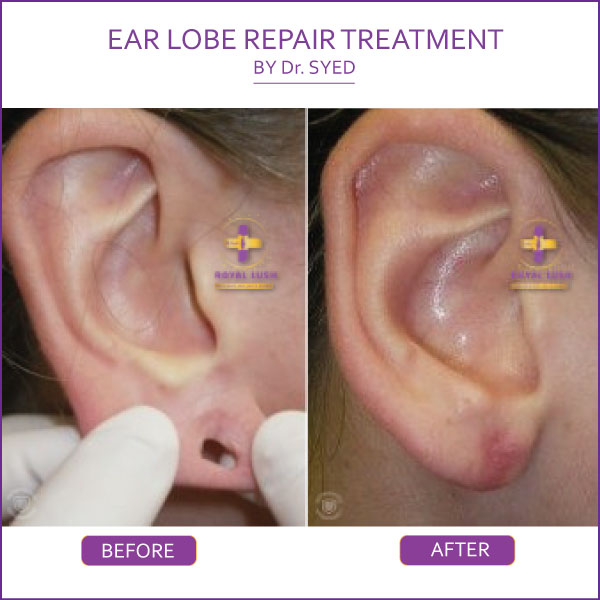 Ear Lobe Repair In Delhi