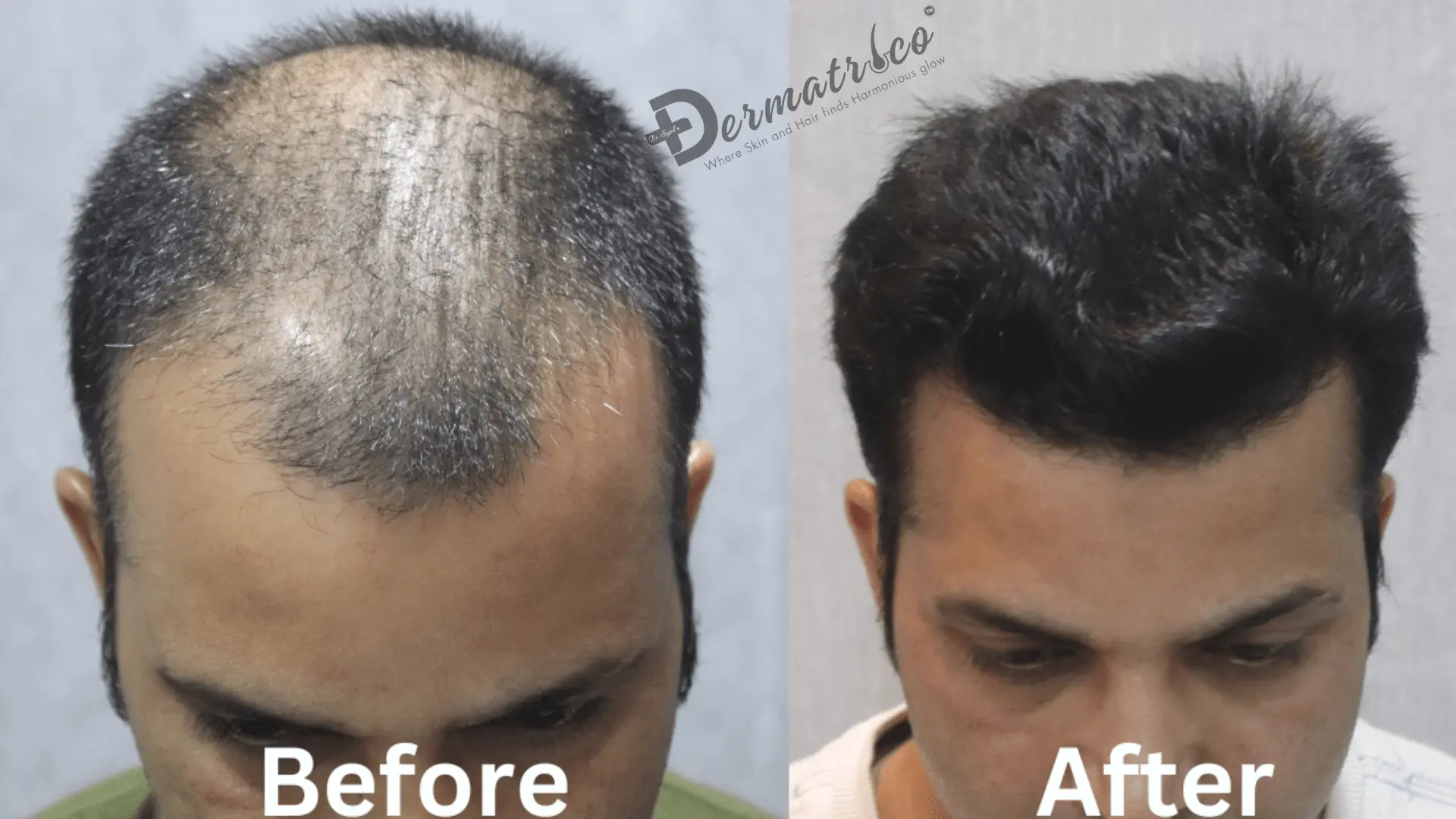 Hair Transplant in Delhi