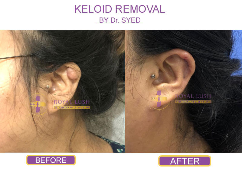 Keloids Removal Treatment in South Delhi