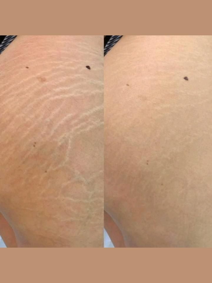 Stretch Marks Treatment at Dermatrico