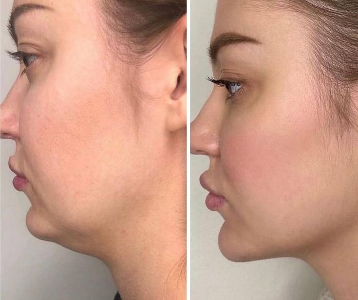 Double Chin Removal In Delhi