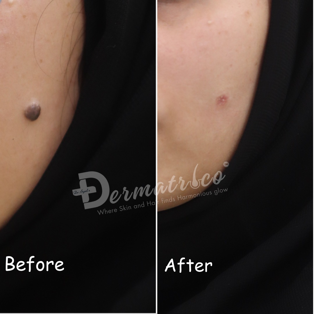 Mole Removal Treatment in Delhi
