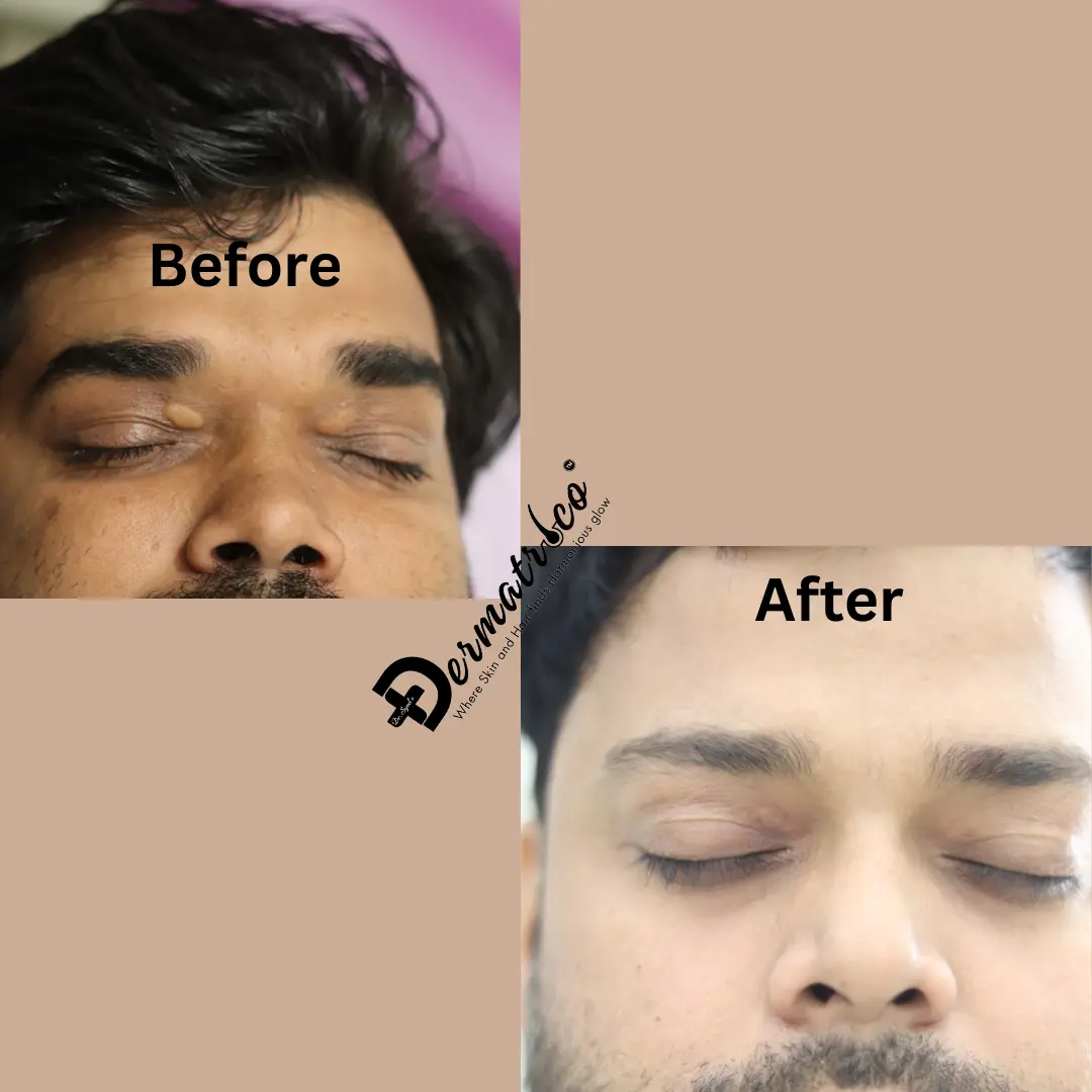 xanthelasma-treatment